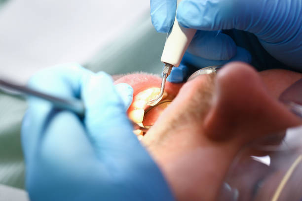 Best Emergency Root Canal Treatment in Dunedin, FL